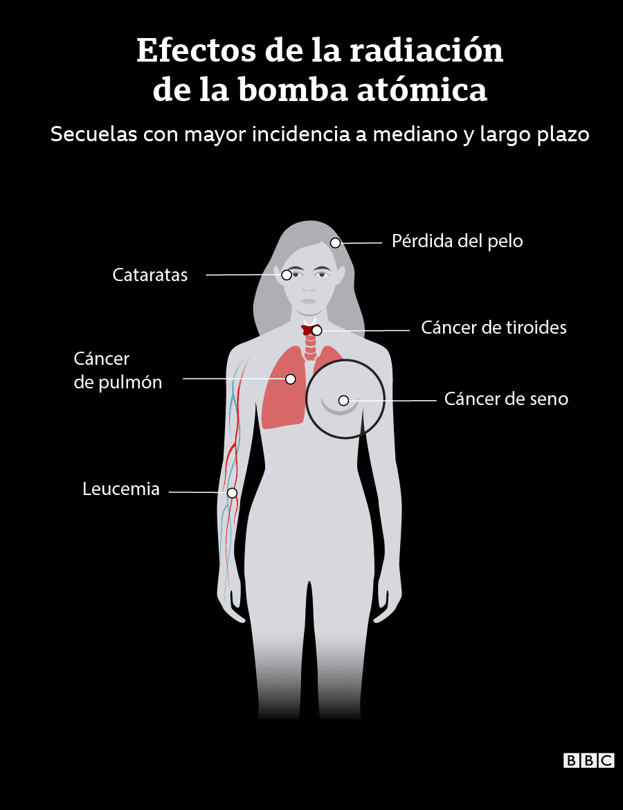 Infografía de los efectos a medio y largo plazo de la radiación: cáncer de pecho, de pulmón, de tiroides; caída de pelo; cataratas.